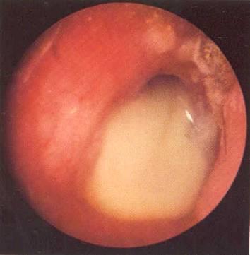 CHRONIC OTITIS MEDIA Frequent in Greenland Prevalence among the highest in the world Historic, skeletal