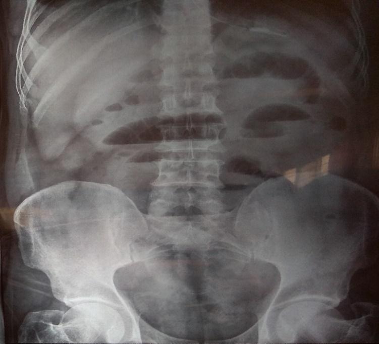 Fig-1: X-ray abdomen showing multiple