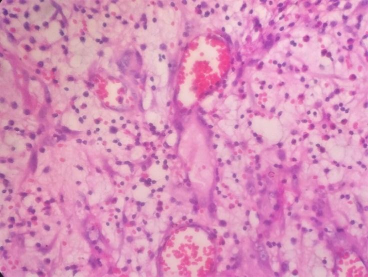 Fig-6: Inflammatory cell infiltrate with proliferating