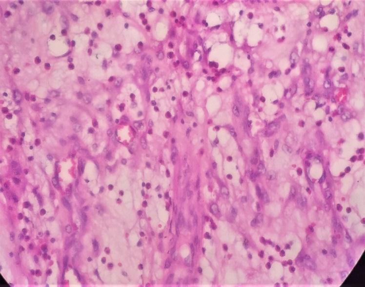 Fig-7: Inflammatory cell infiltrate showing eosinophils (H&E, x 400) DISCUSSION Inflammatory fibroid polyps reveal a slight female preponderance and occur in a wide range from 2 90 years, the mean