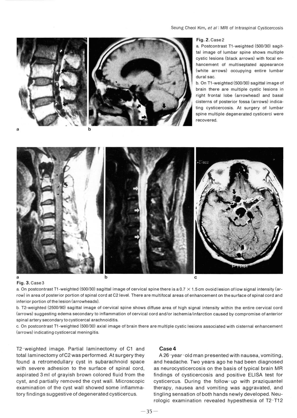 Seung Cheol Kim, et l: MRI of Intrspinl Cysticercosis Fig. 2. Cse 2.