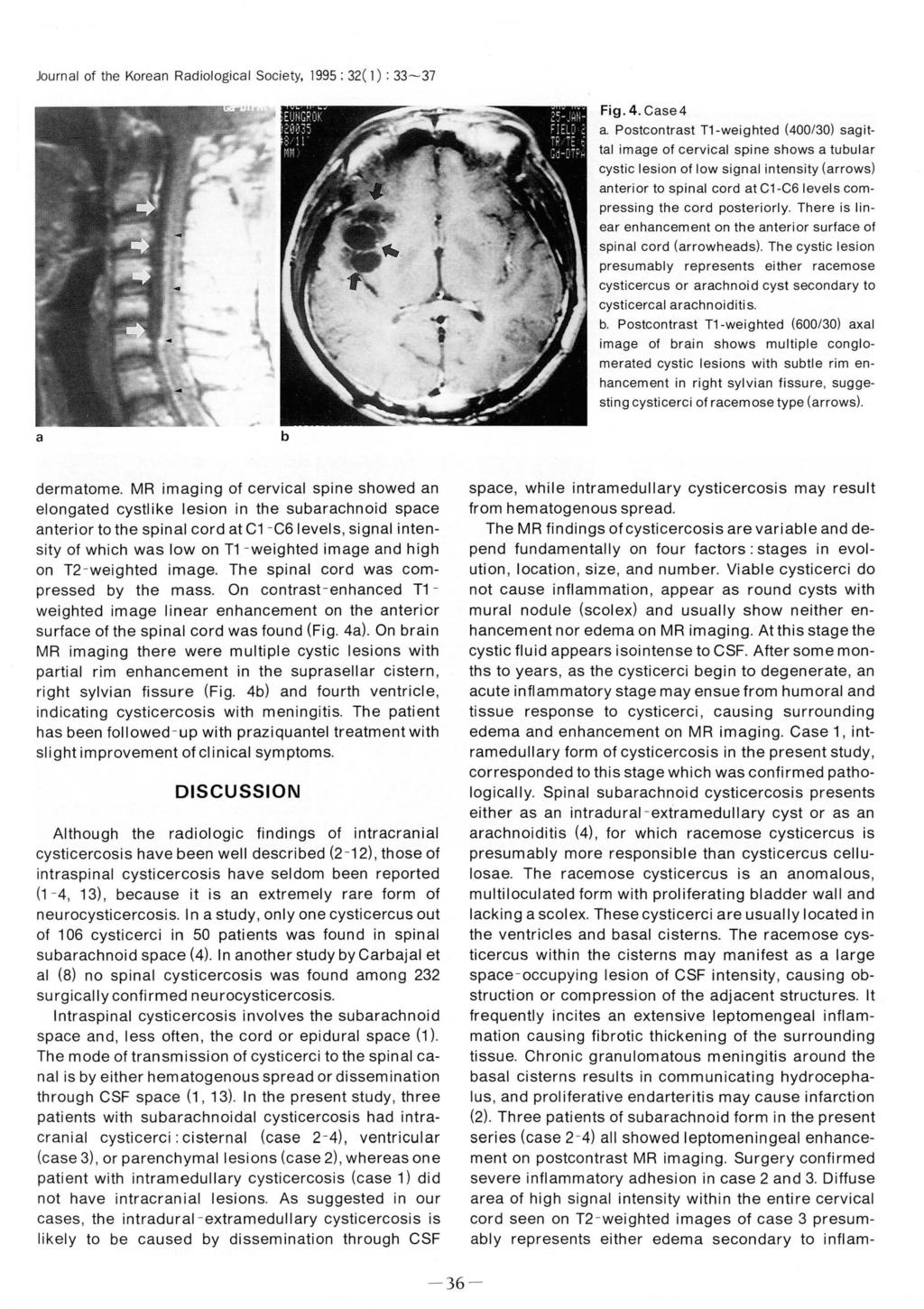 Journl of the Koren Rdiologicl Society, 1995 ; 32( 1) : 33-37 Fig. 4. Cse 4.