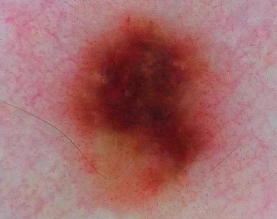 The most common mistakes on dermatoscopy of melanocytic lesions pink nodules, so that we will not overlook melanomas which meet EFG criteria (elevated, firm and growth) [8].