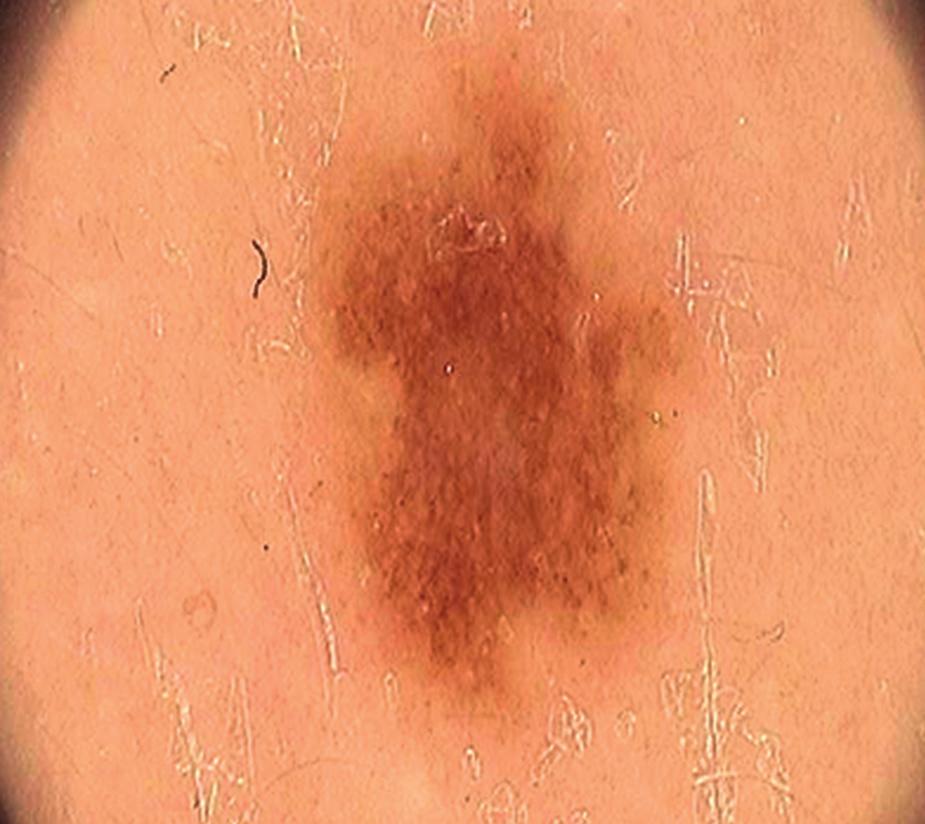The most common mistakes on dermatoscopy of melanocytic lesions Figure 3. Two different melanocytic lesions of the same patient in a profile typical of the individual Figure 4.