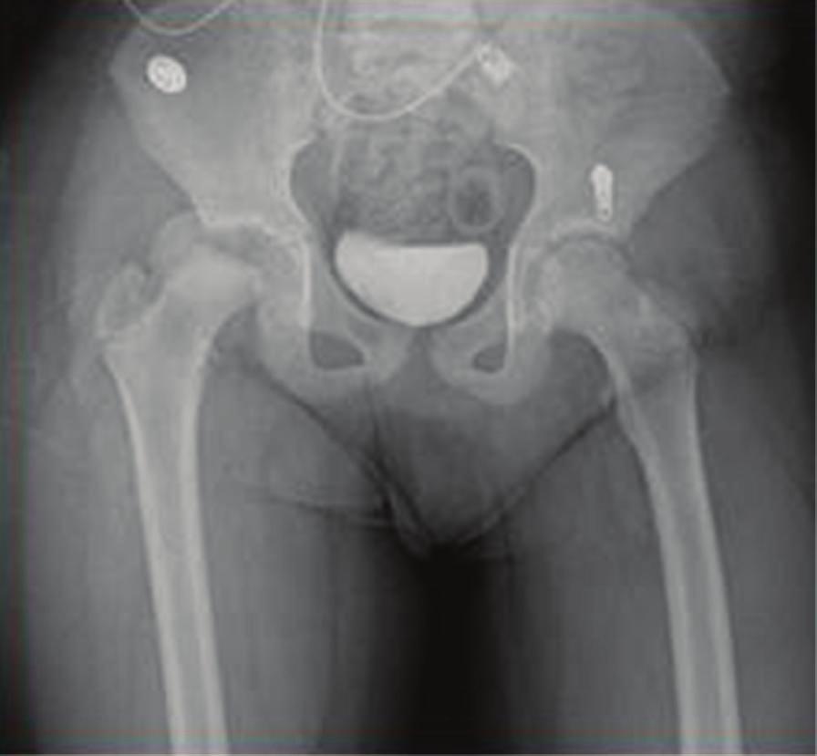2 Case Reports in Orthopedics Figure 1: Patient admitted to our emergency service with right-sided proximal femoral fracture and dislocation.