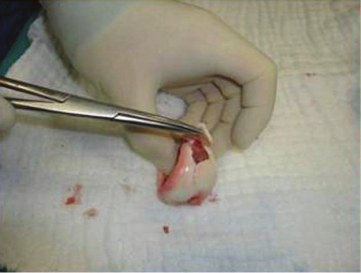 Case Reports in Orthopedics 3 Figure 3: The chondral fragments sealed with fibrin glue before internal fixation.