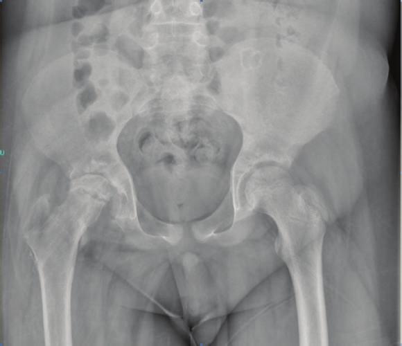 ThisisbecauseinType1btransepiphysealseparation,the femoral head may be dislocated in the acetabulum.