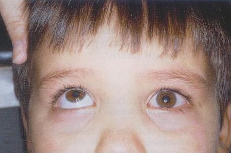 White Eyed Blow Out Fracture Children under 16 Diplopia, pain, restricted EOM, enophthalmos, V2 hypoesthesia,