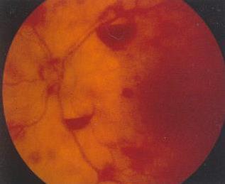 Subretinal, intraretinal, or pre-retinal