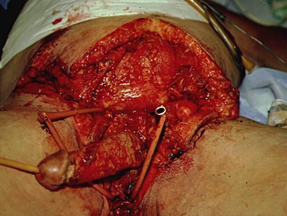 Type 1 - Fournier s gangrene of the perineal region E.