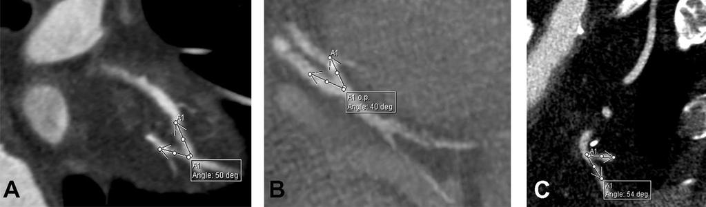 Results Anastomosis angle in distal sequential grafting: 48.60 o for patent vs. 53.97 o for occluded side-to-side anastomoses, 65.12 o for patent vs. 90.