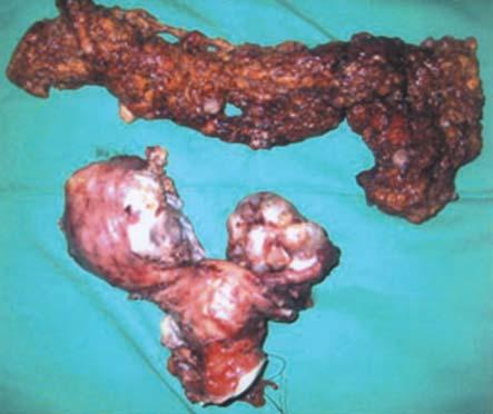 colectomy (R). Fig.