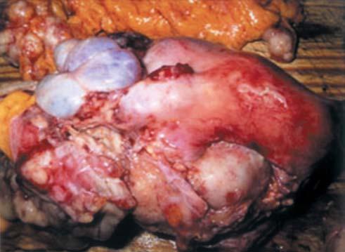 ovarian tumors (R). Fig.