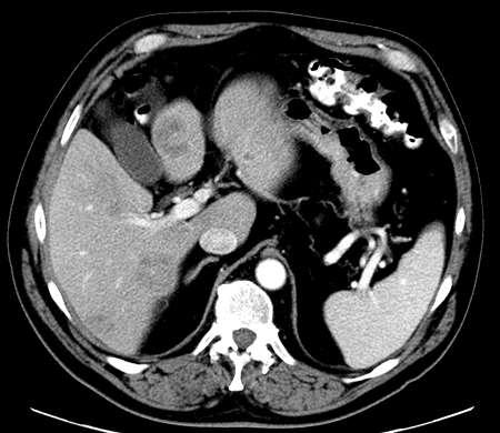 Metastases post-chemotherapy MDCT