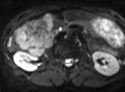 liver MRI: no tumor