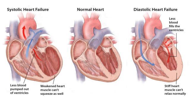 Heart Failure: a major health care problem ~23 million people with heart failure worldwide Heart