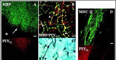 In SPMS white matter, P2Y12 is expressed by phagocytic microglia.