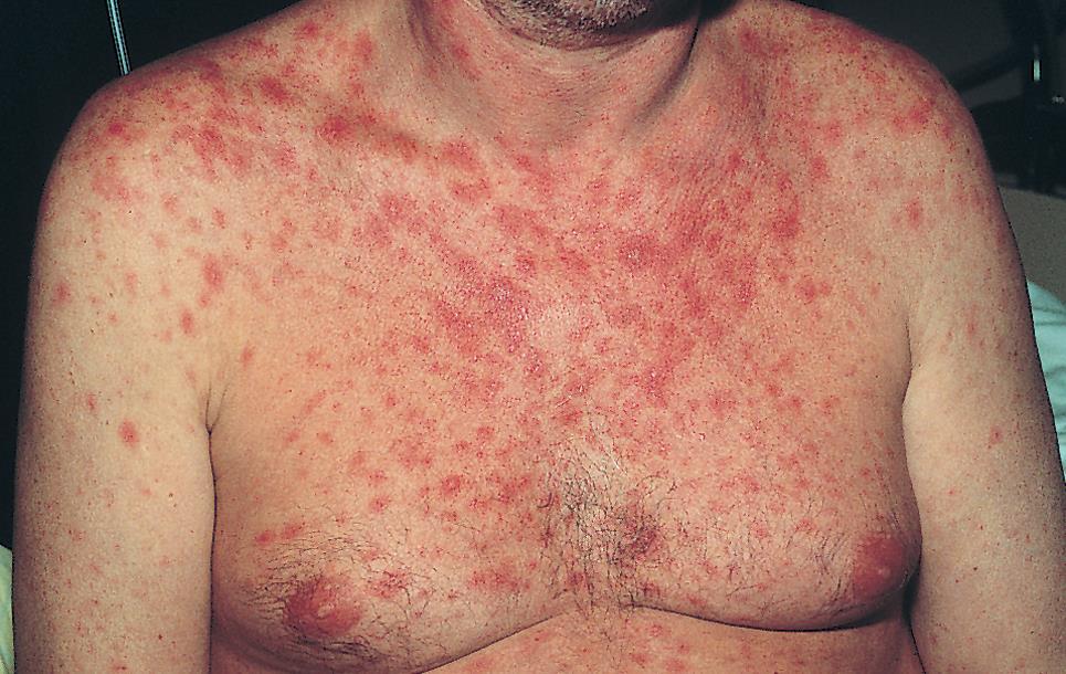 MKI induced RASH 14 Maculopapular rash is characterized by a flat, red area on