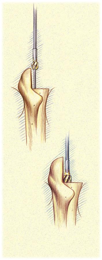 Distal Reaming Fluted & Plasma Straight Stems (continued) Use of the Cylindrical Distal Reamer 127mm & 167mm Straight Stems (continued) Progressively ream until resistance accompanied by cortical