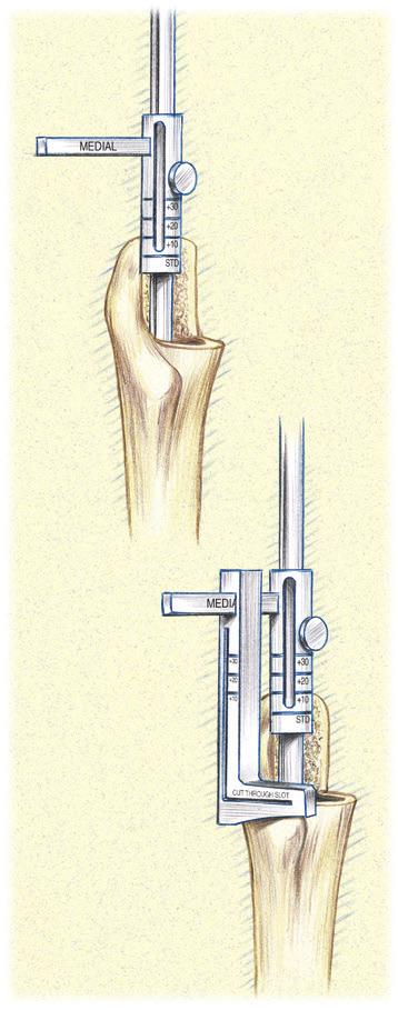 Calcar Post Resection Cutting Guide (continued) Method 2 Bowed Stems Insert the Fluted or Plasma Bowed Distal Stem to its final seating level (refer to Insert the Distal Stem, page 17).