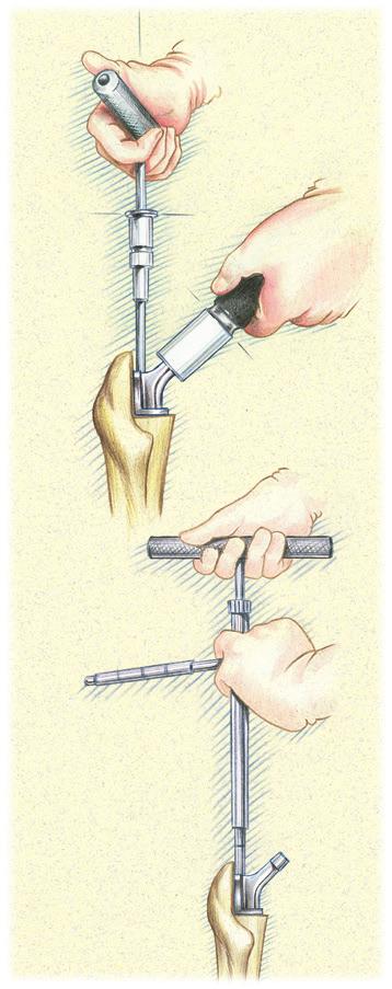 Restoration Modular Calcar Body/Fluted & Plasma Distal Stem Removal If new components are to be disassembled during surgery (i.e., to readjust version) inspect the proximal body and distal stem closely for damage prior to re-impacting the body onto the distal stem.