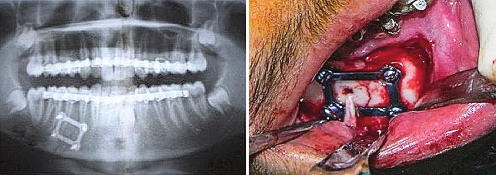 Comparative study between 3-D miniplates versus Champy s miniplates in mandibular fracture treatment Vivek, et al.