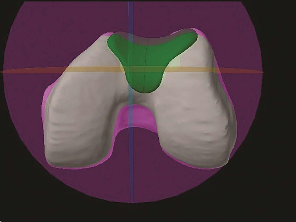 PF Verify 1 (figure B) This pre-set view is identical to PF Primary except that the sagittal plane sections through the superior-medial flange tip.