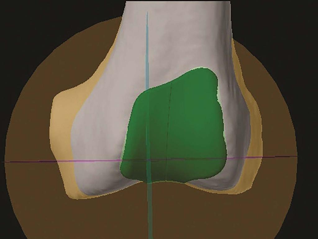 Transverse plane: Sections the PF component through its widest medial/lateral extent. This is useful for verifying size, and medial/lateral position, and internal/external rotation.