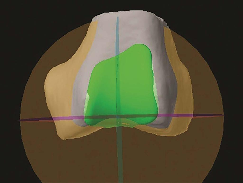 Coronal plane: Sections the PF component just anterior to the distal tongue (patella transition zone). This is useful for verifying patella transition.