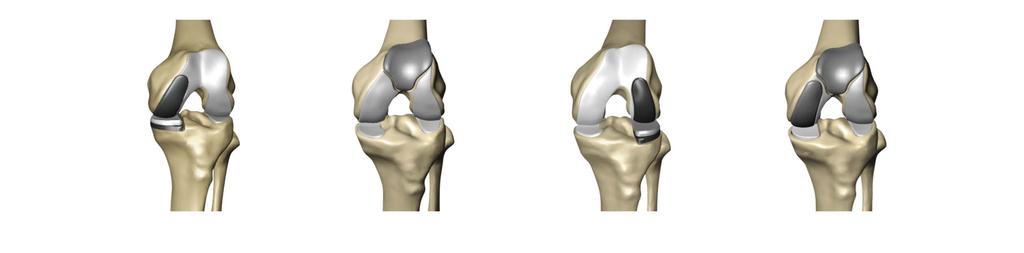 Implant compatibility Medial Patellofemoral Lateral Medial bicompartmental Mako MCK Implant System Options Sizes Part number Femoral implant Left medial/right lateral 1-8 18050X Right medial/left