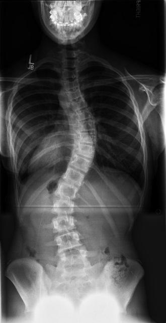 Patient and Family Education Scoliosis About idiopathic scoliosis and its treatment This handout covers the most common type of scoliosis, adolescent idiopathic scoliosis.