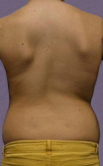 Kyphosis (forward bend) Lordosis (backward bend) The following information is about idiopathic