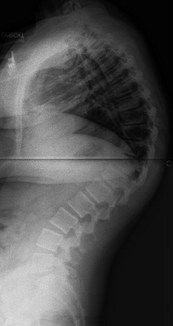 What are the signs and symptoms of scoliosis?