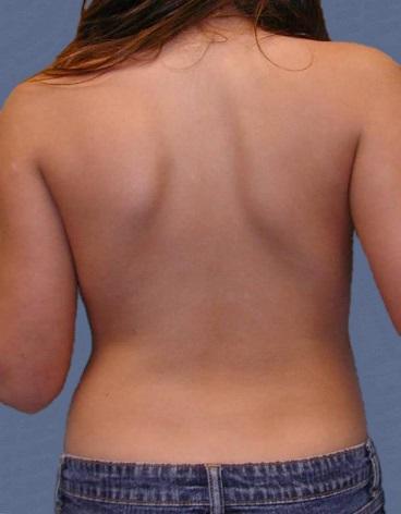 Here are a few other signs of scoliosis: One shoulder is higher than the other. (A slight difference in shoulder height is common in people who do not have scoliosis.