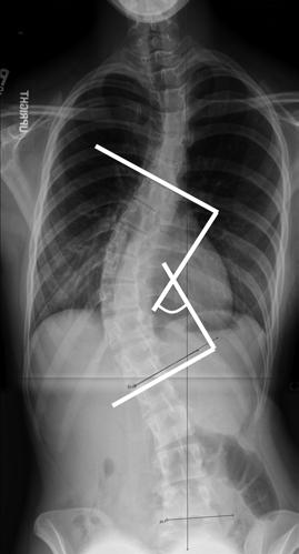 The measurement taken from an X-ray of your child s spine will determine the severity of their scoliosis.
