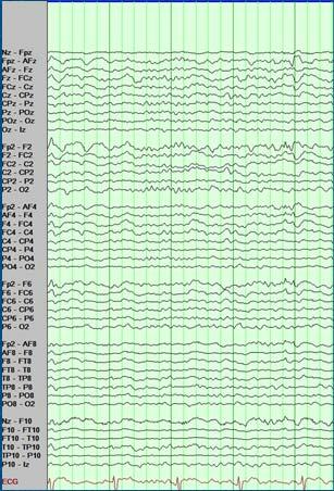 after processing Transverse Bipolar Montage Localization by Conventional EEG Spatial