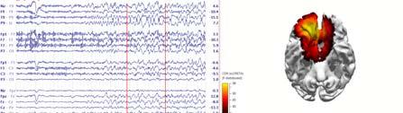 data) Two (or more) dipole method: after finding first bestfit dipole, its contribution to scalp EEG or MEG is subtracted and