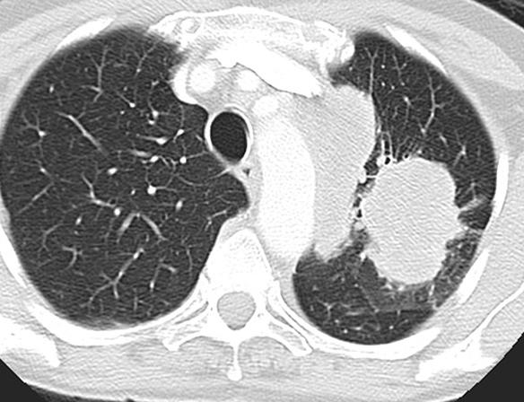T ALK positive lung adenocarcinoma & CT ALK is commonly associated with larger volume &