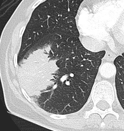 August 2011) ALK Molecular Phenotype in Non Small Cell Lung Cancer: CT Radiogenomic