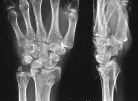 590 D. A. RIKLI, P. REGAZZONI Fig. 3a Radiographs of a 48-year-old patient with an intra-articular two-column fracture with a large dorso-ulnar fragment and metaphyseal comminution.