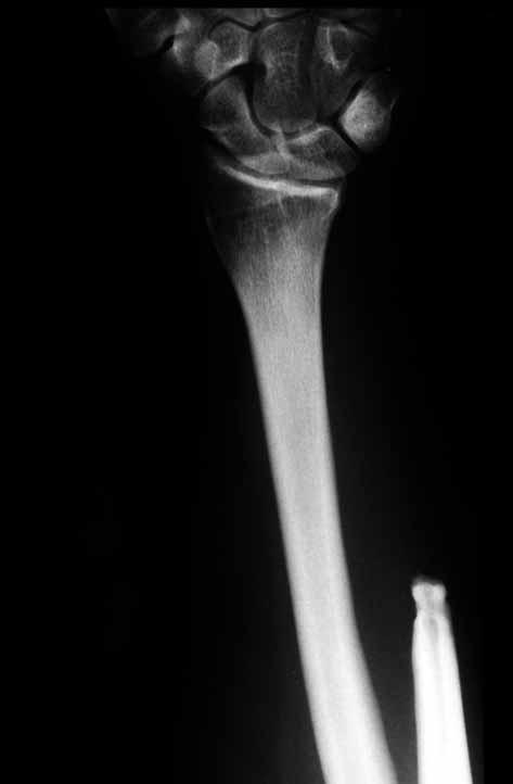 RESECTION OF THE DISTAL ULNA FOR TUMOURS AND STABILISATION OF THE STUMP 487 Fig. 6. Posterior-anterior radiographs of the distal forearm and wrist at 3 years post surgery. Fig. 7.