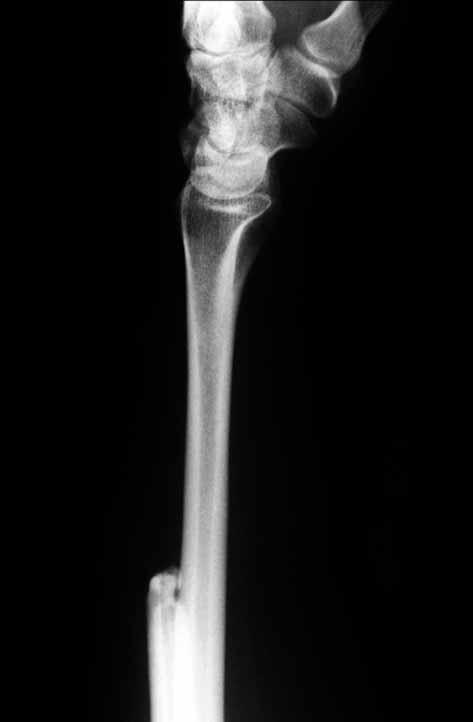 The tendon was passed through a 3-mm drill hole, 5 mm above the end of the ulnar stump in a dorsal to volar direction with the forearm held in supination.