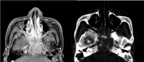 MRI: massive tumor with extensive