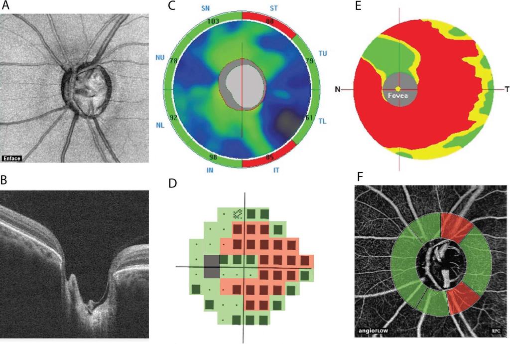(A) En face OCTA image of the optic disc (B) structural OCT (image), (C) RNFL thickness map, (D) VF pattern deviation map, (E) GCC map, and (F) the corresponding contour map