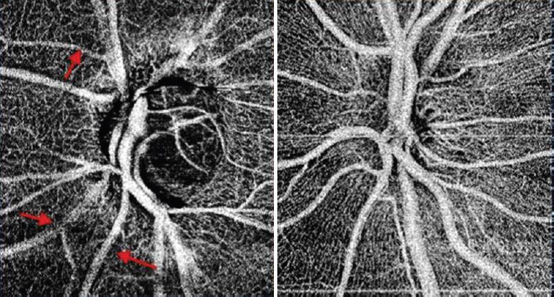 Optical coherence angiography of the optic nerve head of a glaucomatous disc (left) and a healthy disc (right).