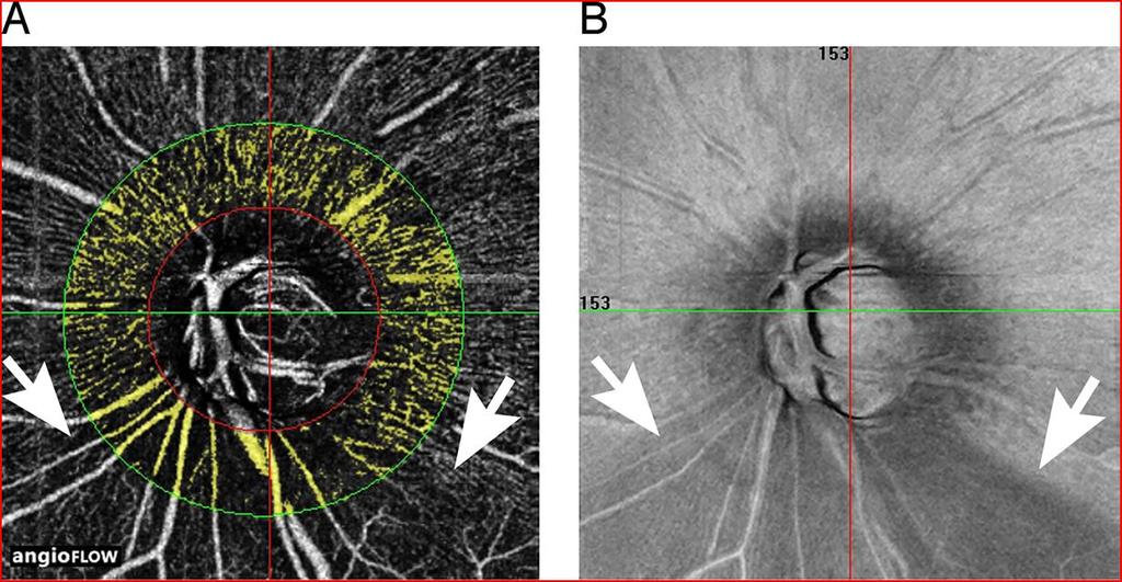 (A) The highlighted RPC (Radial Peripapillary Capillary) of the superficial retina (B) En face image of the retinal nerve fiber layer defects (between arrows) in an eye with POAG.