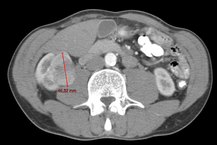 Male, 64 years Previous history : DVT due to factor V Leiden disease 07/ 2008 Bilateral