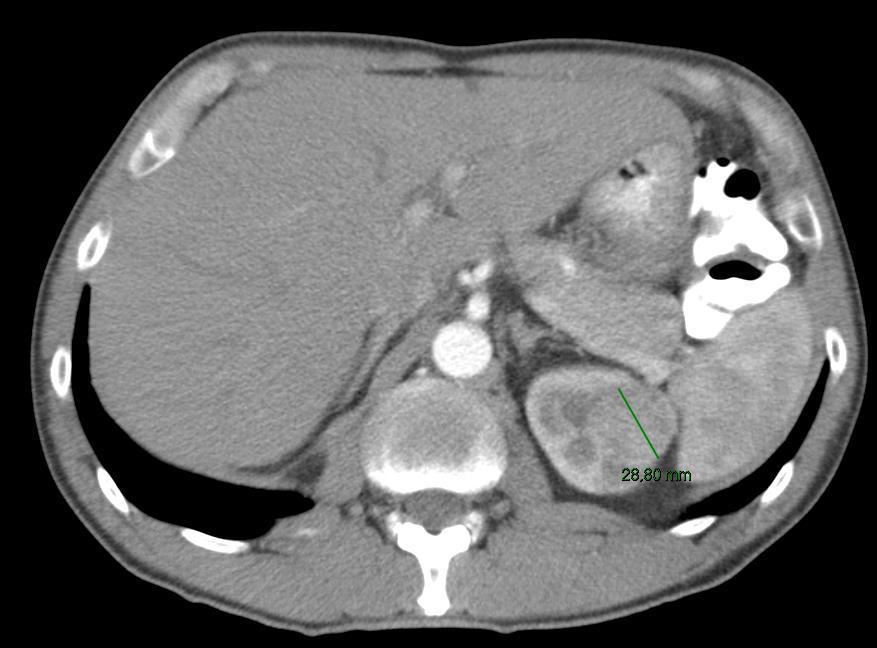 history ct1b cn0 cm0 right kidney 4.5 cm located in mid to lower pole in the hilar area R.E.