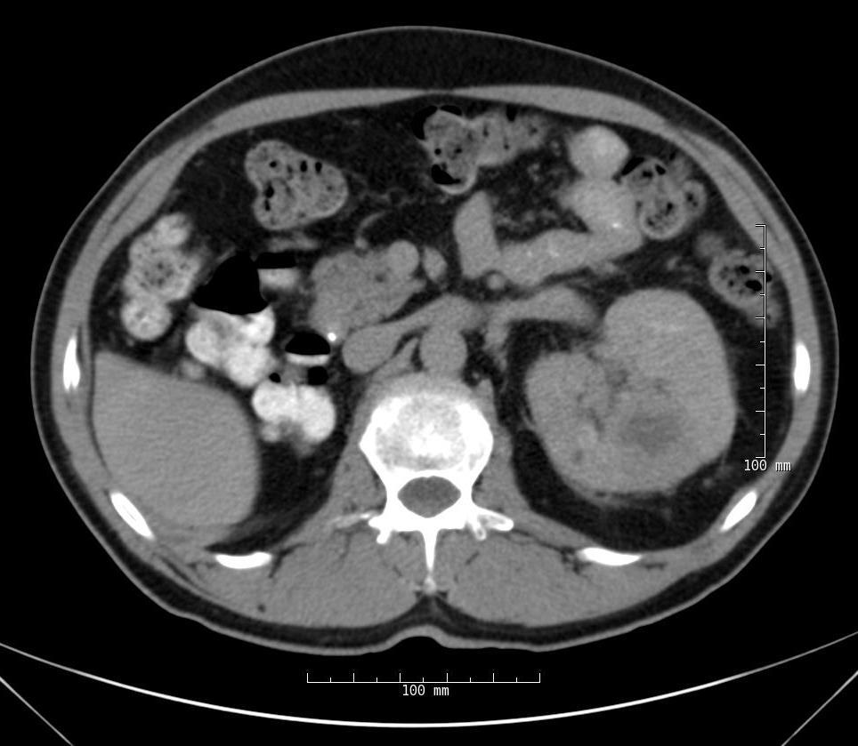 2 cm) within the left kidney