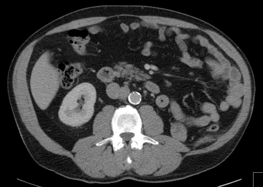 Case presentations: chromophobe renal carcinoma One year later August